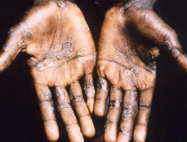 img-Monkeypox1.jpg